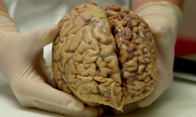 Коли мозок під загрозою: що потрібно знати про менінгоенцефаліт